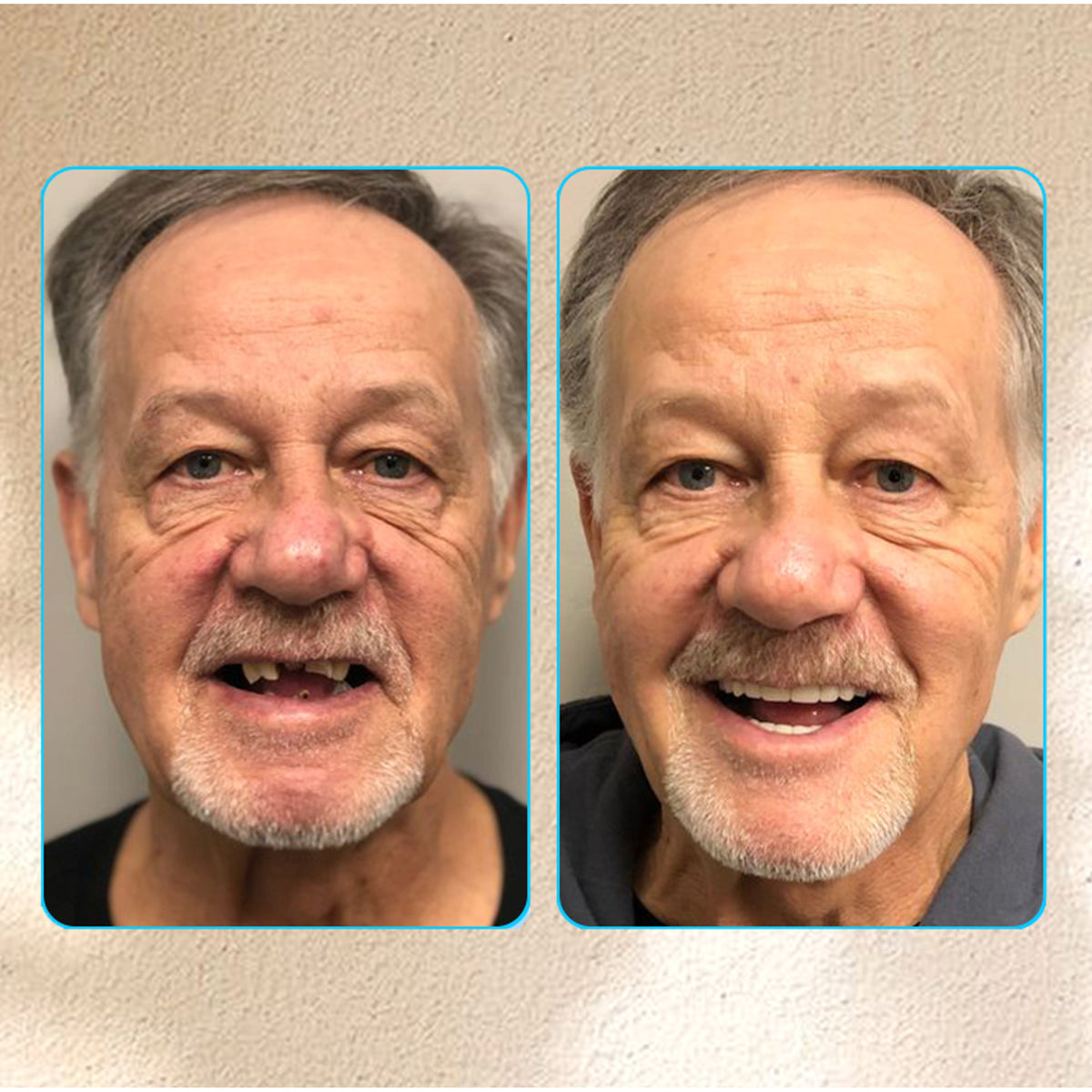 Adsorptive Denture To Restore Your Bite And End Denture Pain - Image 9