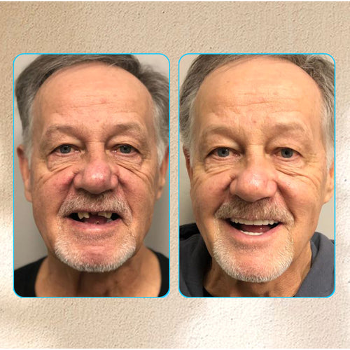Adsorptive Denture To Restore Your Bite And End Denture Pain - Image 9