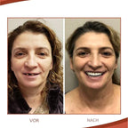 Comfortable Reusable Silicone Denture Set With Natural Fit For Upper And Lower Gums - Image 3