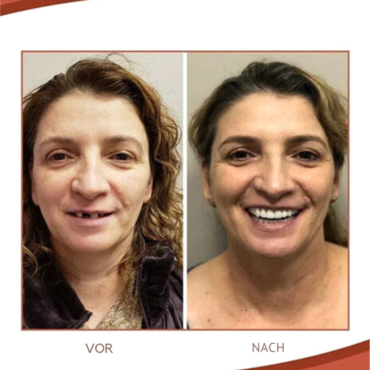 Comfortable Reusable Silicone Denture Set With Natural Fit For Upper And Lower Gums - Image 3