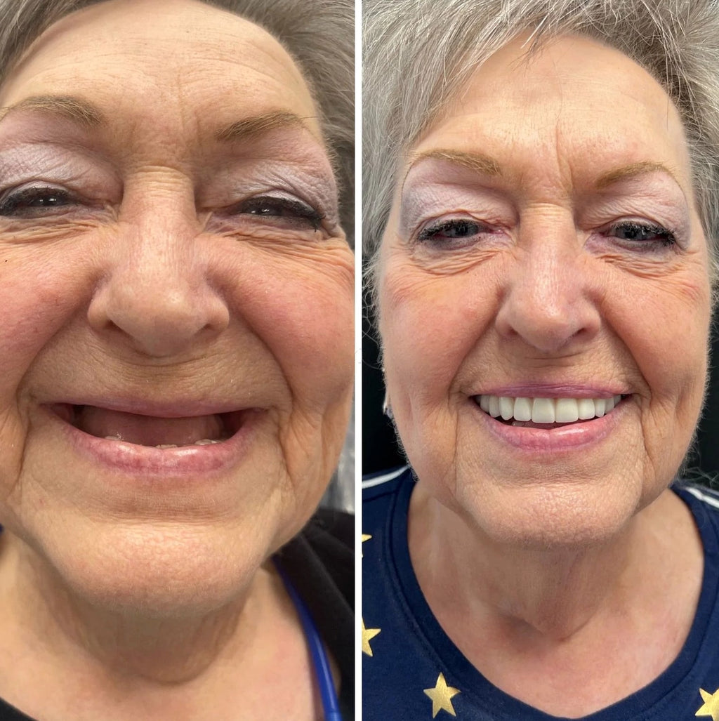 Denture With Silicone Reline For A Secure Smile - Image 2